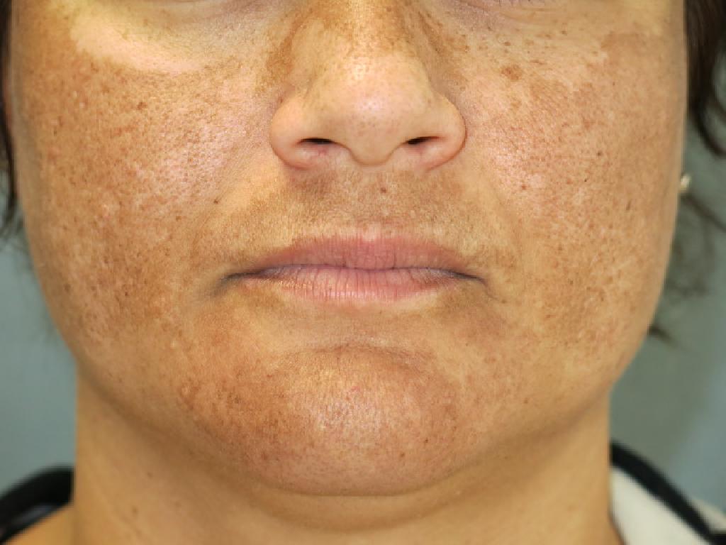 Cuidar da pele tá ON: cuidados antes e após a sessão de laser